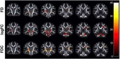 Fixel-Based Analysis and Free Water Corrected DTI Evaluation of HIV-Associated Neurocognitive Disorders